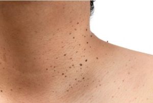 ACROCORDONES1 Cirugia Plastica Quito | Cirujano Plastico Quito | Cirujano Plastico Ecuador | Rinoplastia en Ecuador | Mamoplastia de aumento | Abdominoplastia Lipoescultura | Acido hialuronico | Hilos tensores | Cirugia estetica en Ecuador | Clinica Laser | Reduccion corporal sin Cirugia | Quitar tatuajes con laser Ecuador | Blefaroplastia | Lifting facial | Mommy makeover | post-embarazo para recuperar la figura | VIP