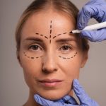 Blefaroplastia Cirugía de Párpados en Quito