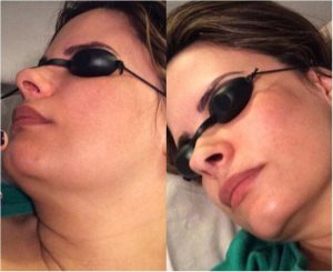 cirugia plastica | cirugia estetica Cirugia Plastica Quito | Cirujano Plastico Quito | Cirujano Plastico Ecuador | Rinoplastia en Ecuador | Mamoplastia de aumento | Abdominoplastia Lipoescultura | Acido hialuronico | Hilos tensores | Cirugia estetica en Ecuador | Clinica Laser | Reduccion corporal sin Cirugia | Quitar tatuajes con laser Ecuador | Blefaroplastia | Lifting facial | Mommy makeover | post-embarazo para recuperar la figura | VIP