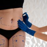 Lipoesculttra – Remodelaje Corporal | Blefaroplastia Cirugía de Párpados en Quito | Otoplastia o cirugía de las orejas | Mini Lipoescultura | Mini Abdominoplastia | Lipoescultura y Perfilamiento Glúteo |Lifting Gluteo | Lifting Facial | Levantamiento Crural | Levantamiento Cejas | Frontoplastia | Cirugía Plástica | Láser | Cirugía Estético | Clínica Láser | Depilación Láser | Belleza Facial | Rinoplastia |Lifting | Limpieza Facial | Rinoplastia | Lipoescultura | Rejuvenecimiento Facial | Mesoterapia |Radiofrecuencia |Laser Depilación |Microdermoabrasión |Limpiezas Faciales | Hilos Tensores | Hilos Tensores Cara | Hilos Tensores Nariz | Lifting Facial | Acido Hialurónico en glúteos |Estetica Cirugia | VIP