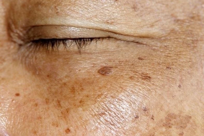 Pigmentación1 Cirugia Plastica Quito | Cirujano Plastico Quito | Cirujano Plastico Ecuador | Rinoplastia en Ecuador | Mamoplastia de aumento | Abdominoplastia Lipoescultura | Acido hialuronico | Hilos tensores | Cirugia estetica en Ecuador | Clinica Laser | Reduccion corporal sin Cirugia | Quitar tatuajes con laser Ecuador | Blefaroplastia | Lifting facial | Mommy makeover | post-embarazo para recuperar la figura | VIP