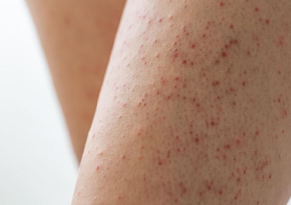 Queratosis1 Cirugia Plastica Quito | Cirujano Plastico Quito | Cirujano Plastico Ecuador | Rinoplastia en Ecuador | Mamoplastia de aumento | Abdominoplastia Lipoescultura | Acido hialuronico | Hilos tensores | Cirugia estetica en Ecuador | Clinica Laser | Reduccion corporal sin Cirugia | Quitar tatuajes con laser Ecuador | Blefaroplastia | Lifting facial | Mommy makeover | post-embarazo para recuperar la figura | VIP