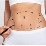 Lipoabdominoplastia 3 en 1 | Aumento de Senos | Reduccion de Senos | Aumento de gluteo | Lipoesculttra – Remodelaje Corporal | Blefaroplastia Cirugía de Párpados en Quito | Otoplastia o cirugía de las orejas | Mini Lipoescultura | Mini Abdominoplastia | Lipoescultura y Perfilamiento Glúteo |Lifting Gluteo | Lifting Facial | Levantamiento Crural | Levantamiento Cejas | Frontoplastia | Cirugía Plástica | Láser | Cirugía Estético | Clínica Láser | Depilación Láser | Belleza Facial | Rinoplastia |Lifting | Limpieza Facial | Rinoplastia | Lipoescultura | Rejuvenecimiento Facial | Mesoterapia |Radiofrecuencia |Laser Depilación |Microdermoabrasión |Limpiezas Faciales | Hilos Tensores | Hilos Tensores Cara | Hilos Tensores Nariz | Lifting Facial | Acido Hialurónico en glúteos |Estetica Cirugia | VIP