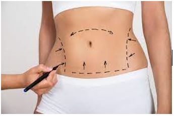 Lipoabdominoplastia 3 en 1 | Aumento de Senos | Reduccion de Senos | Aumento de gluteo | Lipoesculttra – Remodelaje Corporal | Blefaroplastia Cirugía de Párpados en Quito | Otoplastia o cirugía de las orejas | Mini Lipoescultura | Mini Abdominoplastia | Lipoescultura y Perfilamiento Glúteo |Lifting Gluteo | Lifting Facial | Levantamiento Crural | Levantamiento Cejas | Frontoplastia | Cirugía Plástica | Láser | Cirugía Estético | Clínica Láser | Depilación Láser | Belleza Facial | Rinoplastia |Lifting | Limpieza Facial | Rinoplastia | Lipoescultura | Rejuvenecimiento Facial | Mesoterapia |Radiofrecuencia |Laser Depilación |Microdermoabrasión |Limpiezas Faciales | Hilos Tensores | Hilos Tensores Cara | Hilos Tensores Nariz | Lifting Facial | Acido Hialurónico en glúteos |Estetica Cirugia | VIP