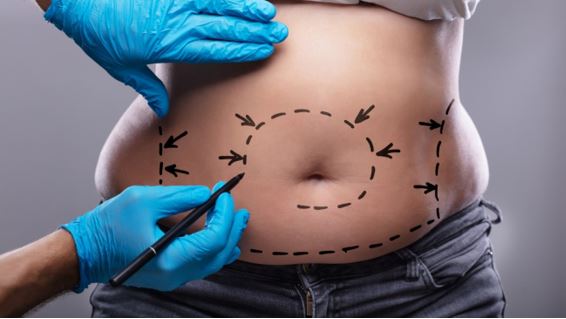 ABDOMINOPLASTIA CIRCULAR Cirugia Plastica Quito | Cirujano Plastico Quito | Cirujano Plastico Ecuador | Rinoplastia en Ecuador | Mamoplastia de aumento | Abdominoplastia Lipoescultura | Acido hialuronico | Hilos tensores | Cirugia estetica en Ecuador | Clinica Laser | Reduccion corporal sin Cirugia | Quitar tatuajes con laser Ecuador | Blefaroplastia | Lifting facial | Mommy makeover | post-embarazo para recuperar la figura | VIP
