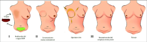 cirugia plastica | cirugia estetica Cirugia Plastica Quito | Cirujano Plastico Quito | Cirujano Plastico Ecuador | Rinoplastia en Ecuador | Mamoplastia de aumento | Abdominoplastia Lipoescultura | Acido hialuronico | Hilos tensores | Cirugia estetica en Ecuador | Clinica Laser | Reduccion corporal sin Cirugia | Quitar tatuajes con laser Ecuador | Blefaroplastia | Lifting facial | Mommy makeover | post-embarazo para recuperar la figura | VIP