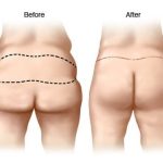 Aumento de gluteo | Lipoesculttra – Remodelaje Corporal | Blefaroplastia Cirugía de Párpados en Quito | Otoplastia o cirugía de las orejas | Mini Lipoescultura | Mini Abdominoplastia | Lipoescultura y Perfilamiento Glúteo |Lifting Gluteo | Lifting Facial | Levantamiento Crural | Levantamiento Cejas | Frontoplastia | Cirugía Plástica | Láser | Cirugía Estético | Clínica Láser | Depilación Láser | Belleza Facial | Rinoplastia |Lifting | Limpieza Facial | Rinoplastia | Lipoescultura | Rejuvenecimiento Facial | Mesoterapia |Radiofrecuencia |Laser Depilación |Microdermoabrasión |Limpiezas Faciales | Hilos Tensores | Hilos Tensores Cara | Hilos Tensores Nariz | Lifting Facial | Acido Hialurónico en glúteos |Estetica Cirugia | VIP
