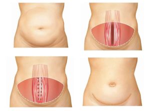 Abdominoplastia Ampliada|Cirugía Plástica | Láser | Cirugía Estético | Clínica Láser | Depilación Láser | Belleza Facial | Rinoplastia |Lifting | Limpieza Facial | Rinoplastia | Lipoescultura | Rejuvenecimiento Facial | Mesoterapia |Radiofrecuencia |Laser Depilación |Microdermoabrasión |Limpiezas Faciales | VIP 