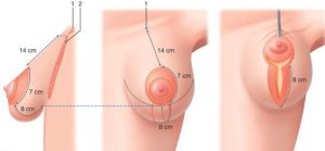 pexia mamaria y aumento mamario