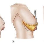 Reduccion de Senos | Aumento de gluteo | Lipoesculttra – Remodelaje Corporal | Blefaroplastia Cirugía de Párpados en Quito | Otoplastia o cirugía de las orejas | Mini Lipoescultura | Mini Abdominoplastia | Lipoescultura y Perfilamiento Glúteo |Lifting Gluteo | Lifting Facial | Levantamiento Crural | Levantamiento Cejas | Frontoplastia | Cirugía Plástica | Láser | Cirugía Estético | Clínica Láser | Depilación Láser | Belleza Facial | Rinoplastia |Lifting | Limpieza Facial | Rinoplastia | Lipoescultura | Rejuvenecimiento Facial | Mesoterapia |Radiofrecuencia |Laser Depilación |Microdermoabrasión |Limpiezas Faciales | Hilos Tensores | Hilos Tensores Cara | Hilos Tensores Nariz | Lifting Facial | Acido Hialurónico en glúteos |Estetica Cirugia | VIP