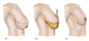 Cirugia Plastica Quito | Cirujano Plastico Quito | Cirujano Plastico Ecuador | Rinoplastia en Ecuador | Mamoplastia de aumento | Abdominoplastia Lipoescultura | Acido hialuronico | Hilos tensores | Cirugia estetica en Ecuador | Clinica Laser | Reduccion corporal sin Cirugia | Quitar tatuajes con laser Ecuador | Blefaroplastia | Lifting facial | Mommy makeover | post-embarazo para recuperar la figura | VIP