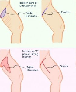 Lifting Crural | Levantamiento Crural | Levantamiento Cejas | Frontoplastia | Cirugía Plástica | Láser | Cirugía Estético | Clínica Láser | Depilación Láser | Belleza Facial | Rinoplastia |Lifting | Limpieza Facial | Rinoplastia | Lipoescultura | Rejuvenecimiento Facial | Mesoterapia |Radiofrecuencia |Laser Depilación |Microdermoabrasión |Limpiezas Faciales | Hilos Tensores | Hilos Tensores Cara | Hilos Tensores Nariz | Lifting Facial | Acido Hialurónico en glúteos |Estetica Cirugia | VIP