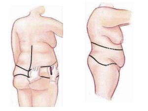 cirugia plastica | cirugia estetica Cirugia Plastica Quito | Cirujano Plastico Quito | Cirujano Plastico Ecuador | Rinoplastia en Ecuador | Mamoplastia de aumento | Abdominoplastia Lipoescultura | Acido hialuronico | Hilos tensores | Cirugia estetica en Ecuador | Clinica Laser | Reduccion corporal sin Cirugia | Quitar tatuajes con laser Ecuador | Blefaroplastia | Lifting facial | Mommy makeover | post-embarazo para recuperar la figura | VIP