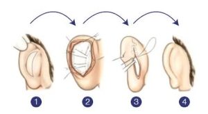 cirugia plastica | cirugia estetica Otoplastia - Cirugía estética de orejas en quito
