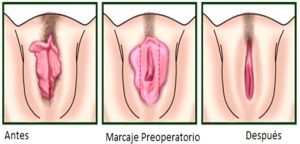 cirugia plastica | cirugia estetica Cirugia Plastica Quito | Cirujano Plastico Quito | Cirujano Plastico Ecuador | Rinoplastia en Ecuador | Mamoplastia de aumento | Abdominoplastia Lipoescultura | Acido hialuronico | Hilos tensores | Cirugia estetica en Ecuador | Clinica Laser | Reduccion corporal sin Cirugia | Quitar tatuajes con laser Ecuador | Blefaroplastia | Lifting facial | Mommy makeover | post-embarazo para recuperar la figura | VIP