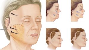 Lifting Facial | Levantamiento Crural | Levantamiento Cejas | Frontoplastia | Cirugía Plástica | Láser | Cirugía Estético | Clínica Láser | Depilación Láser | Belleza Facial | Rinoplastia |Lifting | Limpieza Facial | Rinoplastia | Lipoescultura | Rejuvenecimiento Facial | Mesoterapia | Radiofrecuencia |Laser Depilación |Microdermoabrasión |Limpiezas Faciales | Hilos Tensores | Hilos Tensores Cara | Hilos Tensores Nariz | Lifting Facial | Acido Hialurónico en glúteos |Estetica Cirugia | VIP